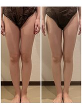 クレビア(CRE'BIA)/１回の施術でむくみ撃退