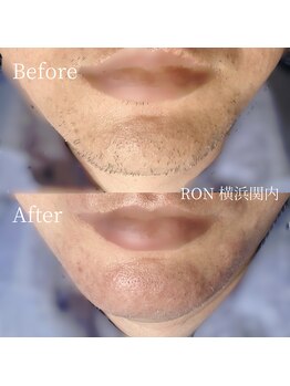 サロンロン 横浜関内(SALON RON)/髭の脱毛/美容電気脱毛