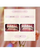 プラスビー 2号店(+b)/ホワイトニングビフォーアフター
