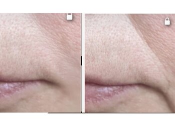 ビジュー(BIJOU)/プラピール