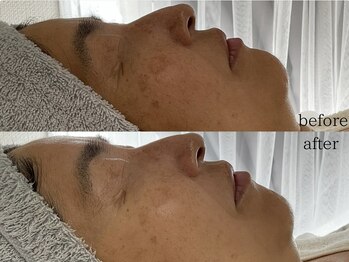 ステラ(Stella)/50代施術症例