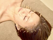 ドリームスタイル 川崎駅前(Dream Style)/頭痛・頭の重さには頭鍼