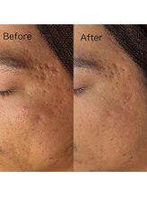 ベリスユイット(BELLIS HUIT)/【男性もok！1ヶ月後の肌変化】