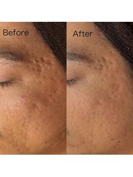 ベリスユイット(BELLIS HUIT)/【男性もok！1ヶ月後の肌変化】