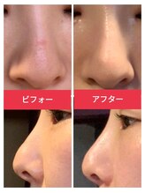 リコメンス(Recommence)/高鼻小鼻きょう正