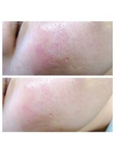 アネラ(ANELA)/HERMOSA