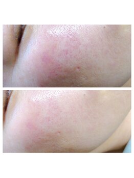 アネラ(ANELA)/HERMOSA