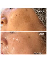 マイルーチェ 可児川合店(MyLuce)/シミ改善6ヶ月