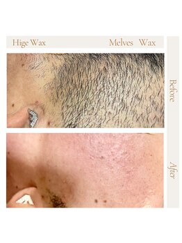 メルベスワックス(MELVES WAX)/髭ダブル脱毛