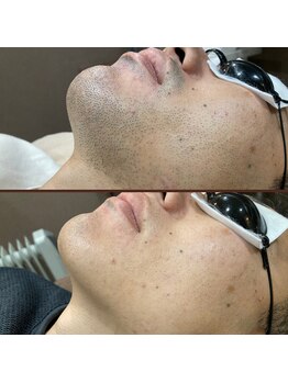 メンズキュー(Men's Cue)/脱毛4ヶ月