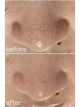 毛穴塾/鼻毛穴洗浄＋最新美容ララピール