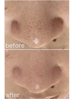 毛穴塾/鼻毛穴洗浄＋最新美容ララピール