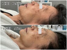 エミマス ボーテ(Emimas Beaute’)/６０代半ば 小顔矯正＆幹細胞