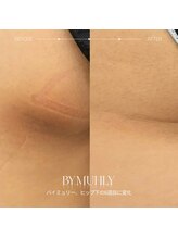 アーヒル(A”-HILU)/メラニンケア　ヒップ下