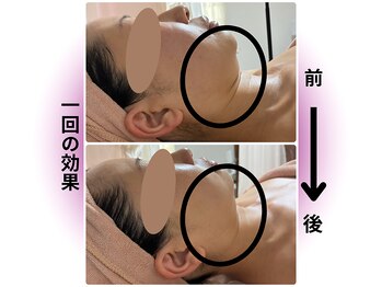 カリアンヌ/小顔/フェイスライン