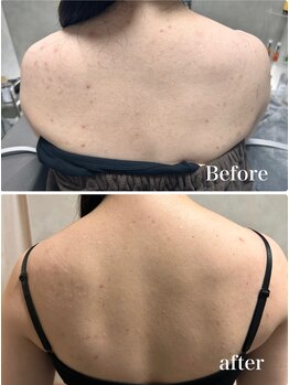 オーパーツ(OOPARTS)/血流ケアで背中ニキビケアも◎