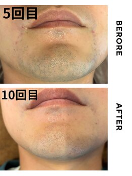 メロウ(mellow)/なかなか抜けにくい方の症例☆