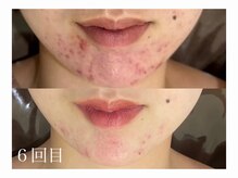 ホワイトアクア 加古川店(WHITE AQUA)/ハーブピーリングで肌荒れ改善