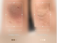 エメ 名古屋栄店(aimer)/LEMELLA <メラニンケア>