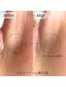 目元に特化！小じわ対策エクソソーム導入