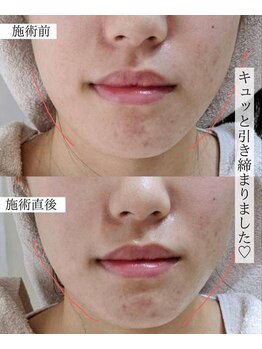 ハジュ(HAJU.)/フォト光フェイシャル