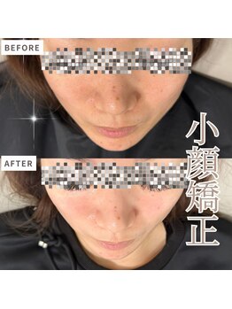 マヴィ くずは店(MavY.)/ノンニードル水光注入で小顔