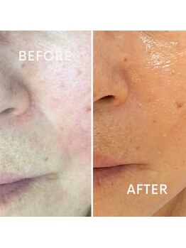 バーグトータルビューティー(bague total beauty)/光フェイシャル