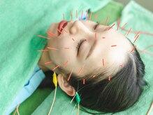 ボディーキュア アオイ(Body cure Aoi)/美容鍼＋身体調整