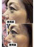 目尻シワ取り☆気になる笑いシワを薄くします！一回でも効果あり！おススメ！