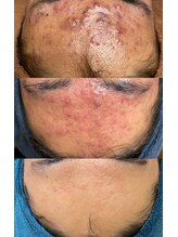 ソリッジ肌管理室/ニキビケア