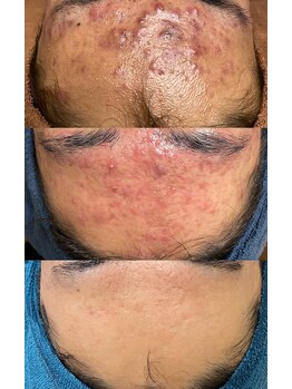 ソリッジ肌管理室/ニキビケア