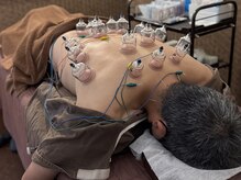 チャチャエイム整骨院 鍼灸院/【鍼灸】体の疲れやコリに！