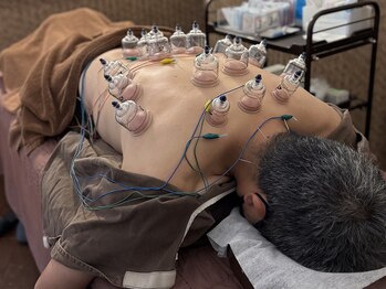 チャチャエイム整骨院 鍼灸院/【鍼灸】体の疲れやコリに!