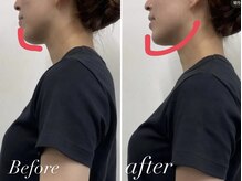 サンアップ(Sun UP)/【Before after】施術1回目