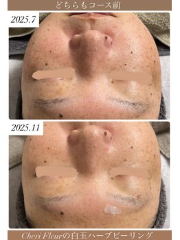 シェリ フルール(Cheri Fleur)/継続することで肌質改善!