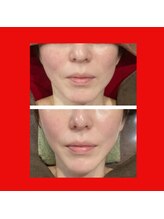 ラシクビューティールーム/小顔　食い縛りケア