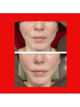 ラシクビューティールーム/小顔　食い縛りケア