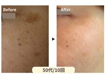 美男美女 奈良三条店/繰り返すシミ対策