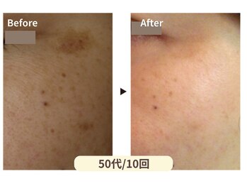 美男美女 奈良三条店/繰り返すシミ対策