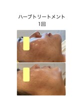 ココロ(KoKoRo)/肌質改善ハーブトリートメント