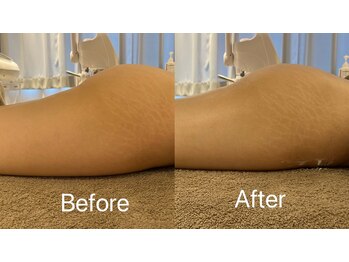 マドモアゼル 麻布十番/痩身インディバ