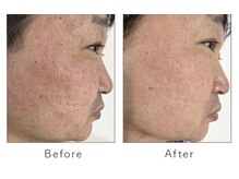 マリーローランメンズグレース(Marryrolan MensGrace)/リベルハーブピーリング症例