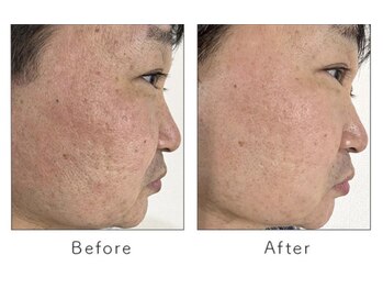 マリーローランメンズグレース(Marryrolan MensGrace)/リベルハーブピーリング症例