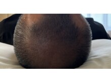 ボニータ(Bonita)/(ヘッド)ヒト羊膜幹細胞エステ