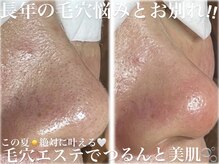 カピリナ(ka pilina)の雰囲気（何をやっても変わらなかった毛穴をスッキリ一掃！毛穴レス肌へ♪）