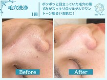 フローフシ∞/【毛穴洗浄】毛穴の黒ずみ改善