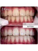 イージーホワイトニング 神戸三宮店(easy whitening)/お客様の症例写真です★