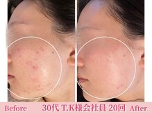 アメリイ 百合ヶ丘 新百合ヶ丘(Amerii)/ハーブピーリング/ニキビ/毛穴