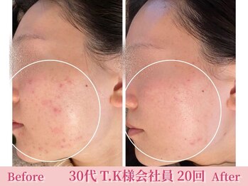 アメリイ 百合ヶ丘 新百合ヶ丘(Amerii)/ハーブピーリング/ニキビ/毛穴