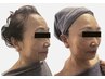 NEW!【医療提携◎最新エレクトロポレーション】美容成分導入 輝き肌へ